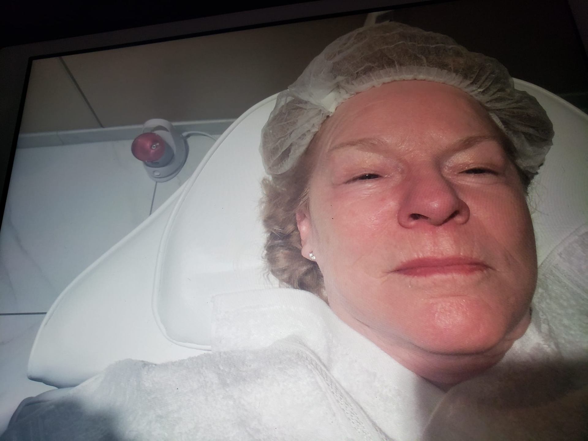 Facial lifting result — after