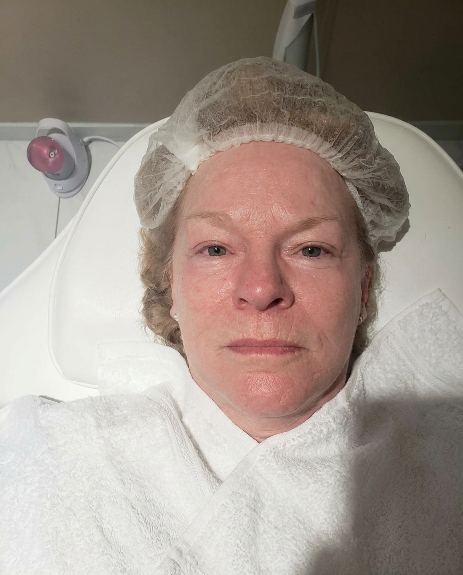 Facial lifting result — after