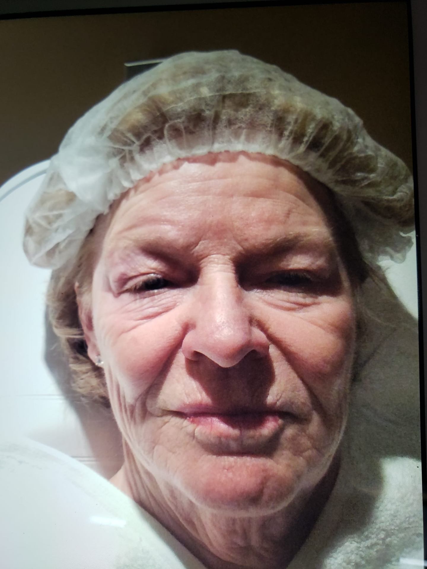 Facial lifting result — before