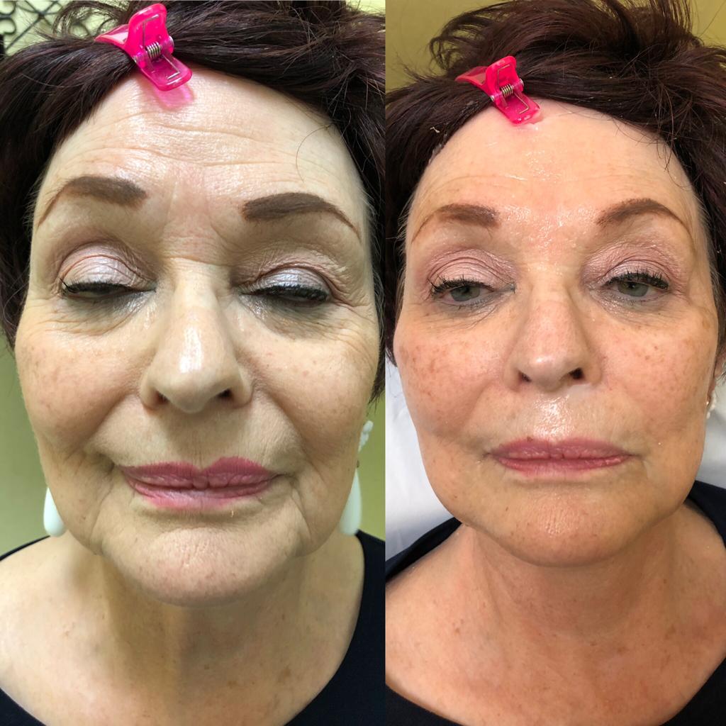 Before and after lifting facial showing visible smoothing and lift